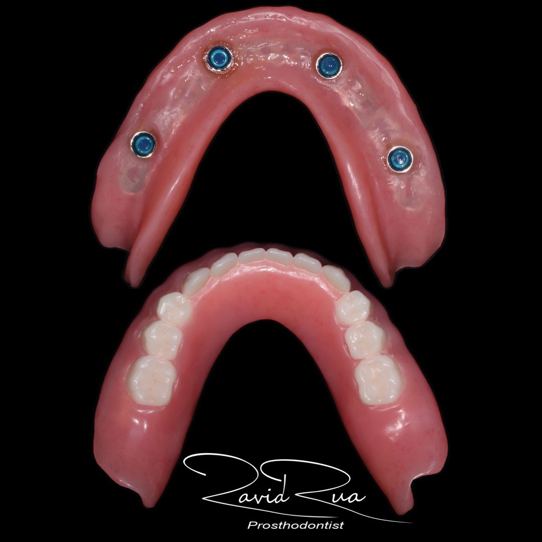 TC Cape Coral Case 16.3 Top and bottom implants overdentures
