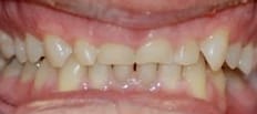 Crowns before  7 Rotter