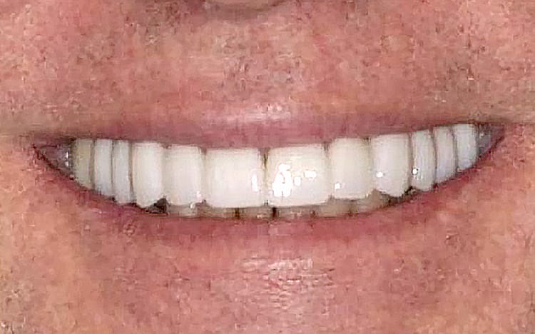 22. Patient KN (14 teeth)_ Porcelain crowns on upper 14 teeth After