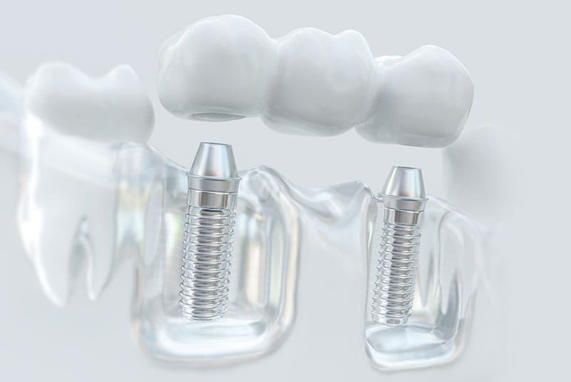 Multi-Implant Bridge Multi-Implant Bridge