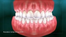 Clear Aligner Technology (Impression) 006