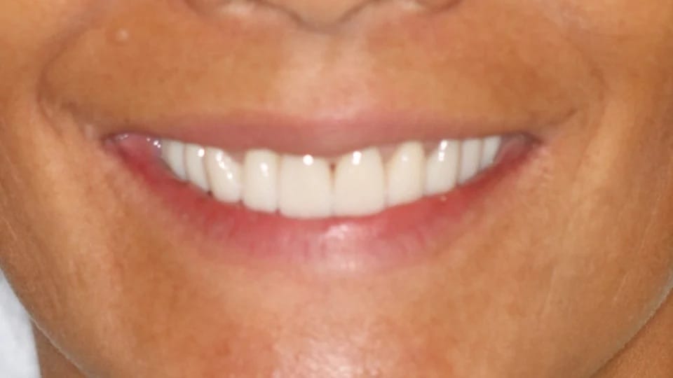 Anastasia Smile 11 after image