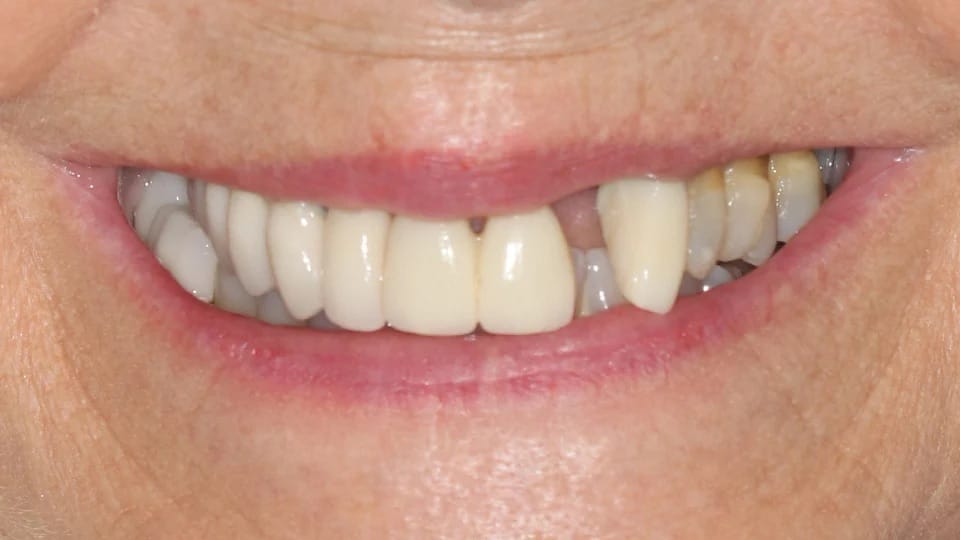 Anastasia Smile 06 before image