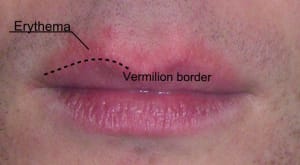 Oral Herpes