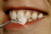 Porcelain Veneers