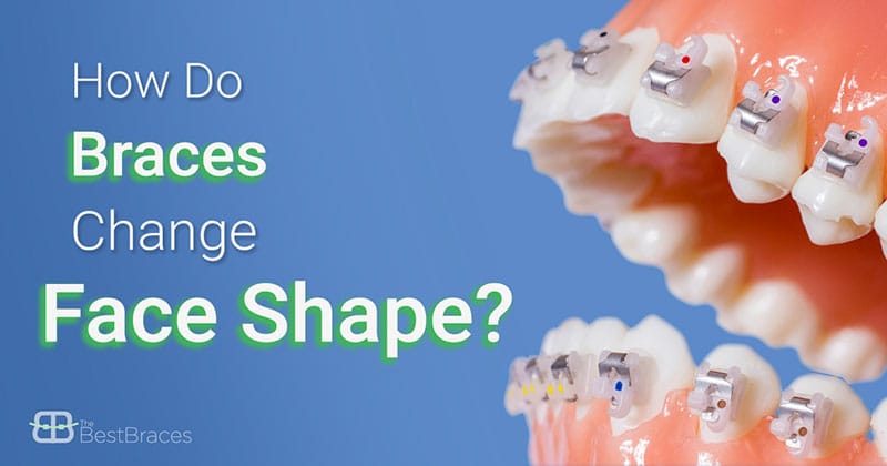 Best Braces How Do Braces Change Your Face Shape? Best Braces How Do Braces Change Your Face Shape?