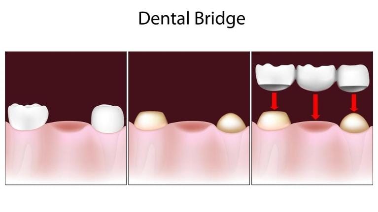 Dental Bridge