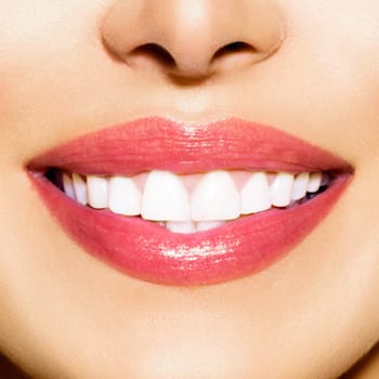 Veneers