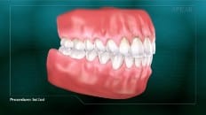 Root Canal image 005