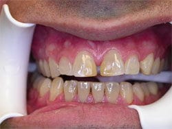 Bonding & Whitening before