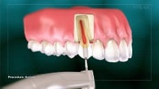 Root Canal image 002