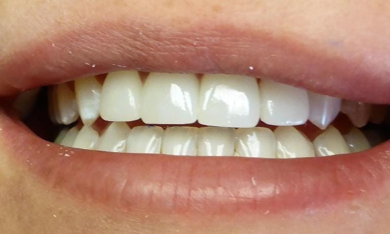Grapevine After Broken Teeth