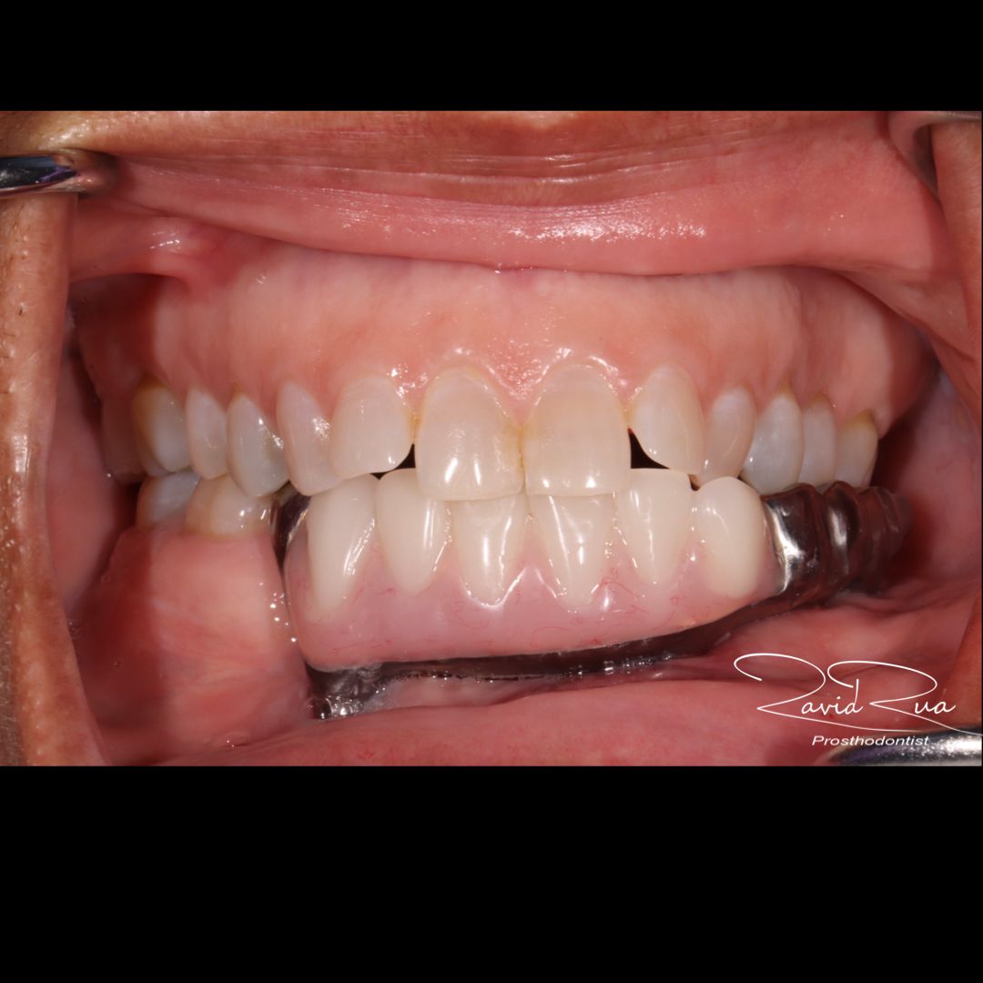 TC Cape Coral Case 10.2 Rib graft and All on 4 Segmental Hybrid for a cancer survival patient