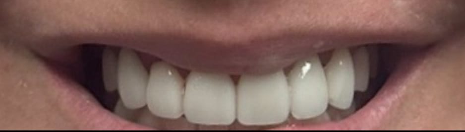 Bright Smiles Marble Falls Case 4 after
