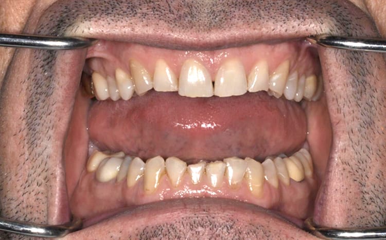 25. Patient PT (22 teeth)_ Combination of orthodontic work prior to 12 porcelain crowns on upper teeth and 10 porcelain crowns on lower teeth Before
