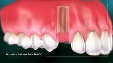 Single Implant (Anterior - Healing Cap) 002
