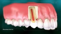 Root Canal image 001
