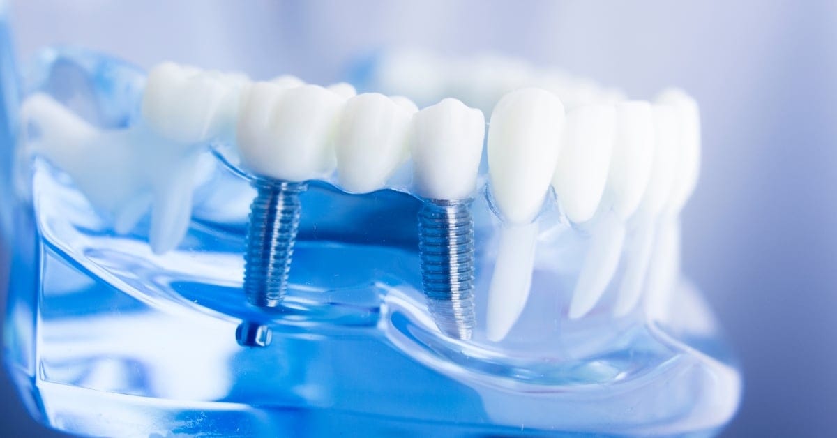 Same-Day Care How Technology is Revolutionizing Restorative Dentistry May 2025 Blog Same-Day Care How Technology is Revolutionizing Restorative Dentistry May 2025 Blog