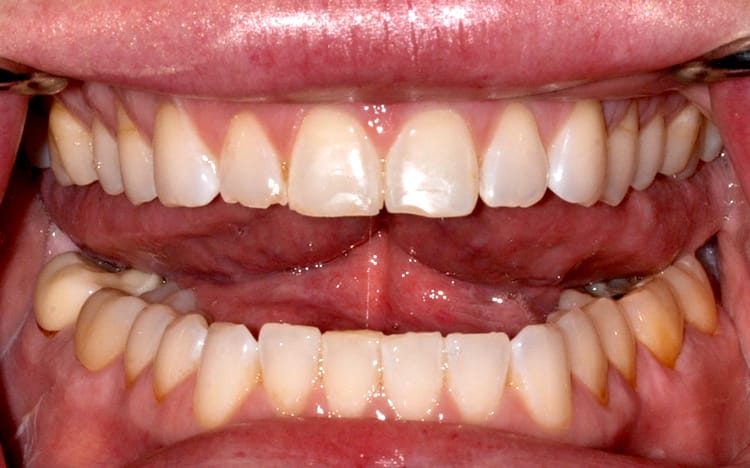 11. Patient KM (8 teeth)_ 8 porcelain crowns on upper front teeth Before.jpg