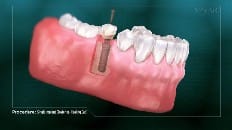 Single Implant (Posterior- Healing Cap) 005