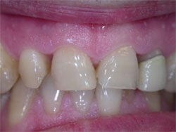 Veneers before
