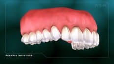 Connective Tissue Graft 004