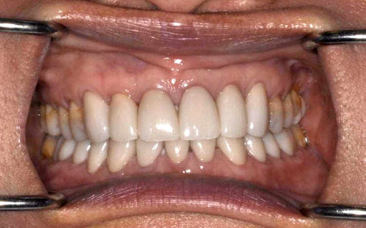 23. Patient LL (14 teeth)_ 6 porcelain crowns on upper front teeth and 11 porcelain crowns on lower teeth After