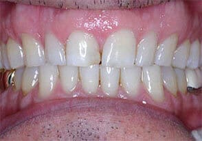 ballston smile gallery case-9-before