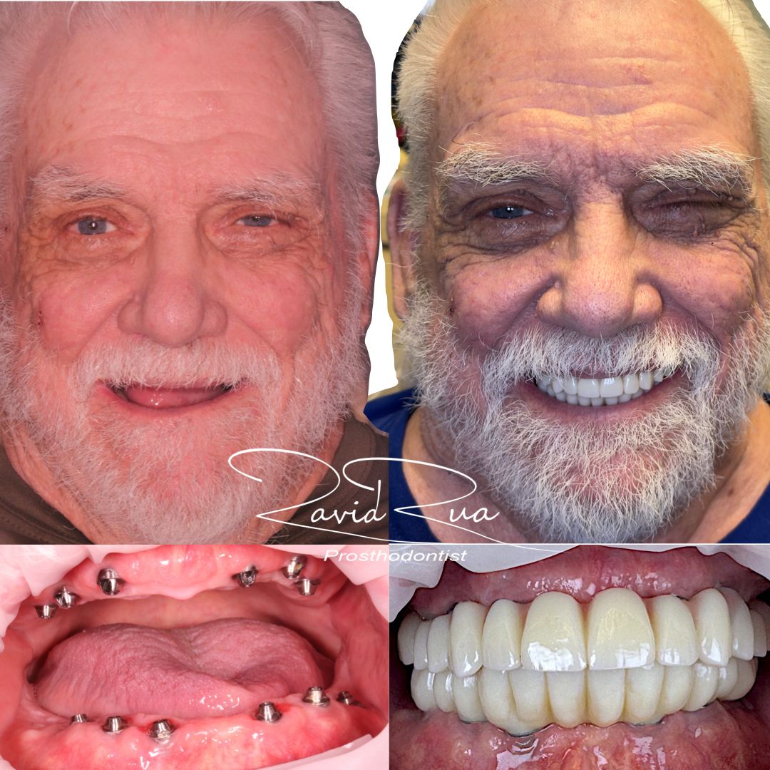 TC Cape Coral Case 3 Top and bottom All on 6 implants