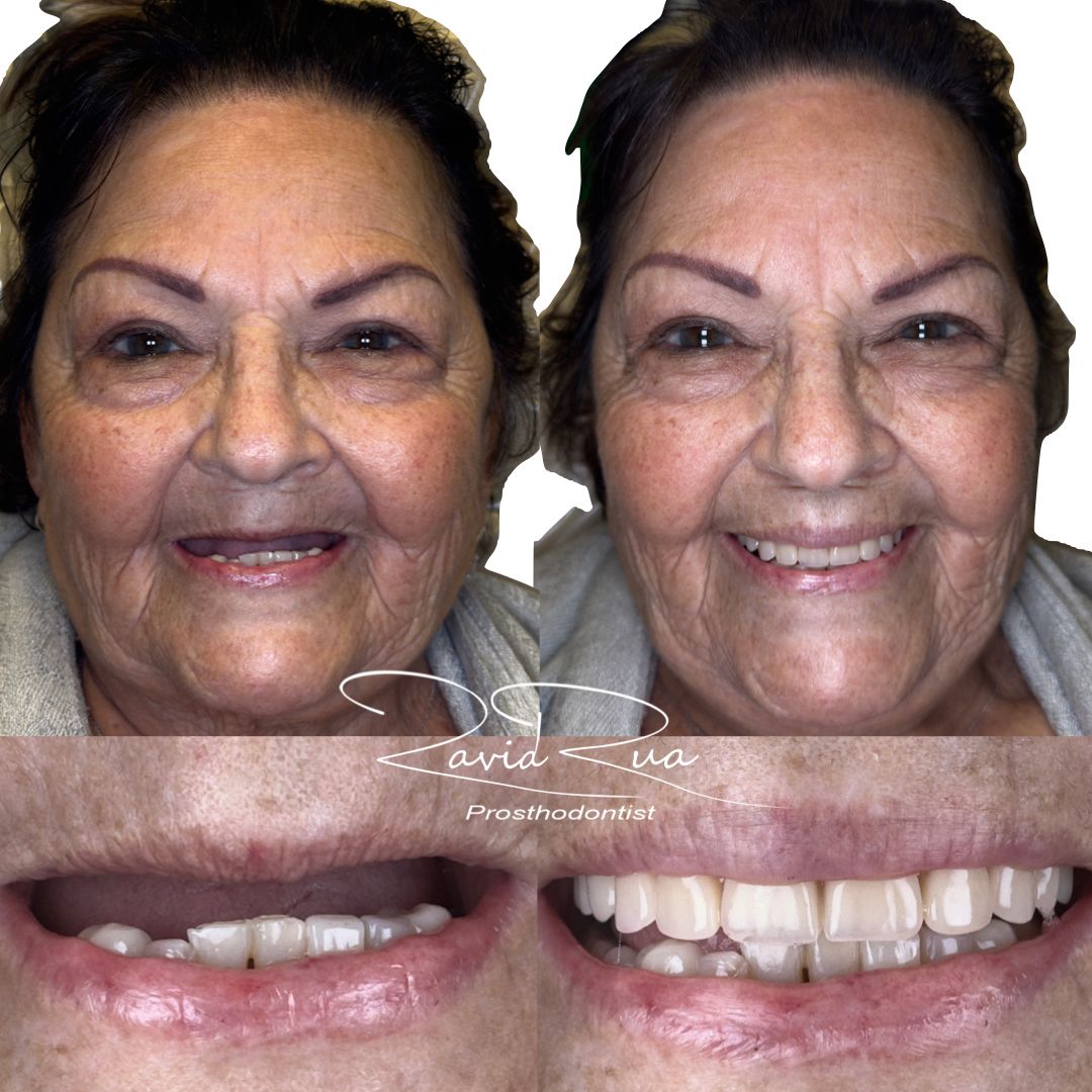 TC Cape Coral Case 2 Top denture