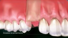 Bone Graft (Socket Preservation) 004