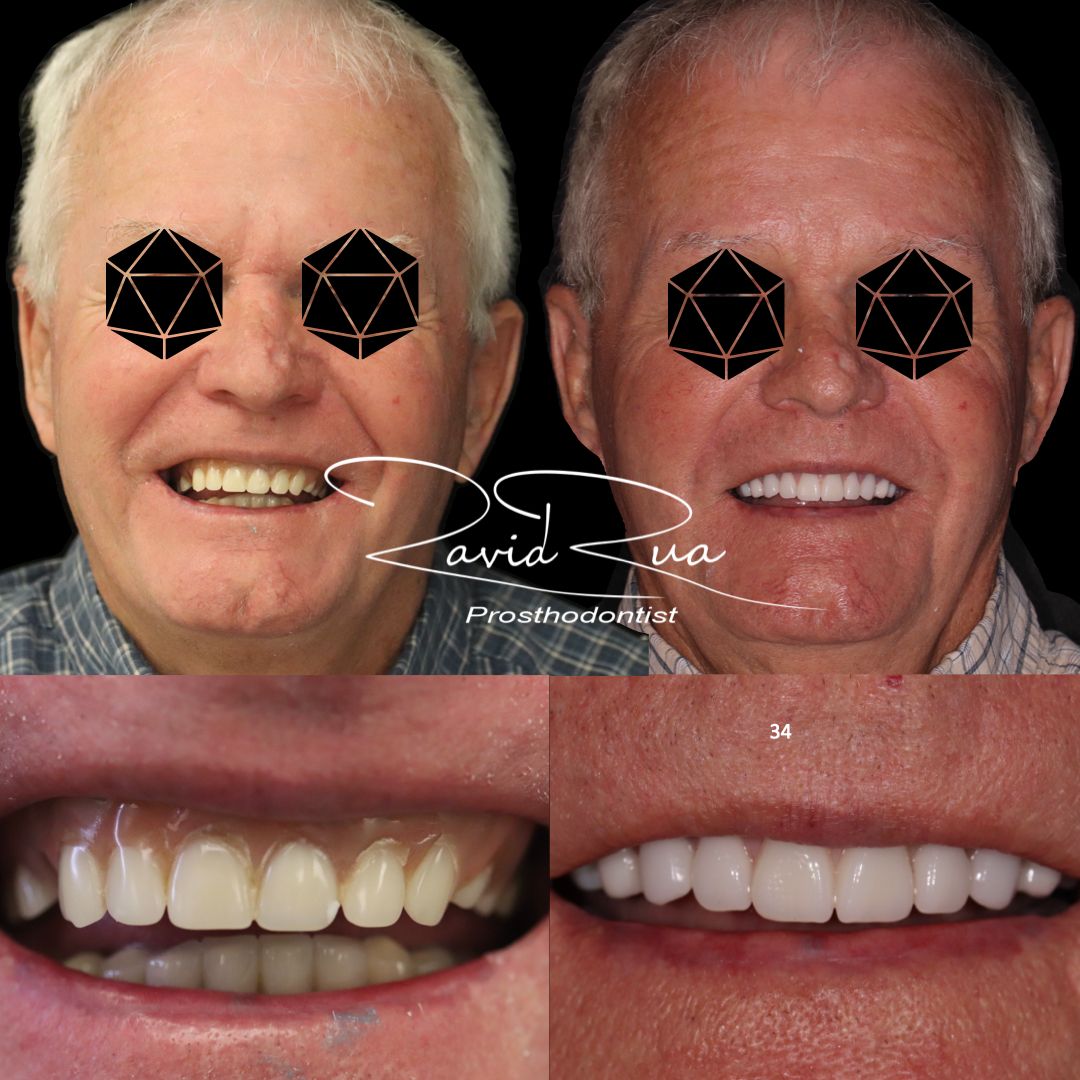 TC Cape Coral Case 16 Top and bottom implants overdentures