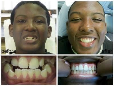 Before and after