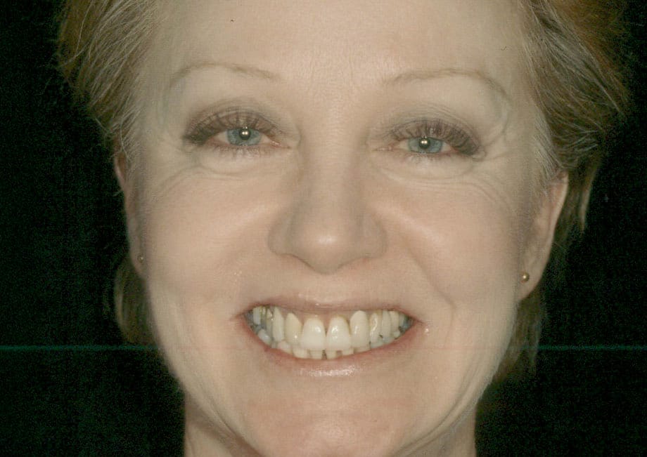 Rasner Smile gallery before 18