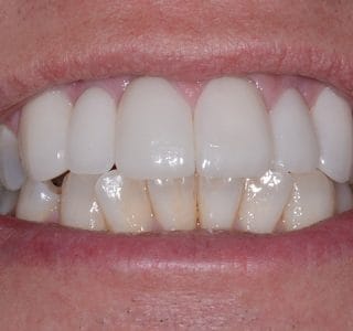 Dental Implants & Crowns After