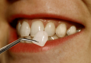Tooth repair