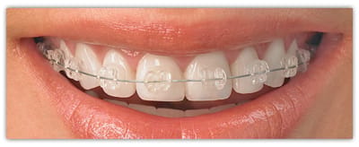 Six month smile