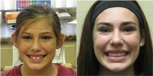 Before and after