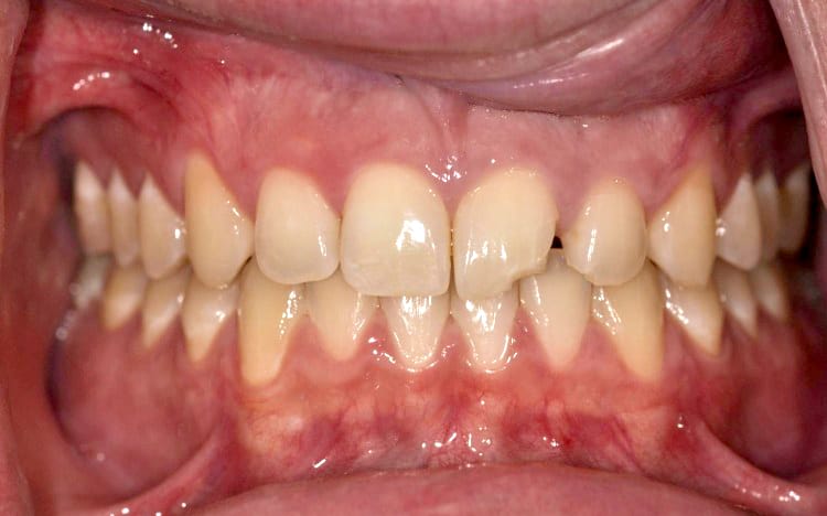 1. Patient EW (1 tooth) Before
