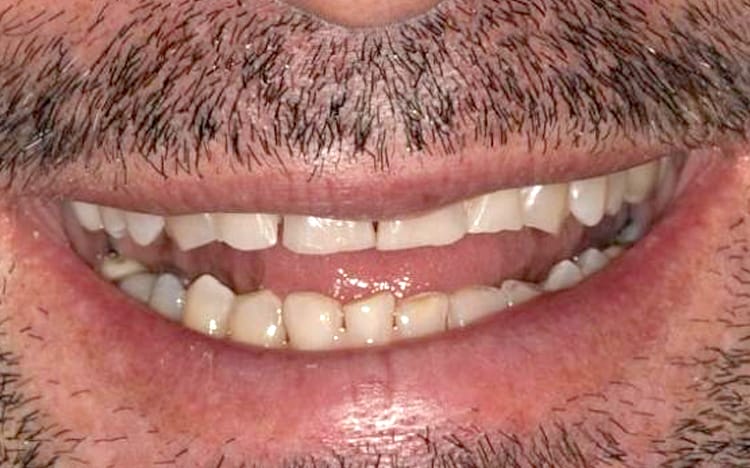25. Patient PT (22 teeth)_ Combination of orthodontic work prior to 12 porcelain crowns on upper teeth and 10 porcelain crowns on lower teeth Before