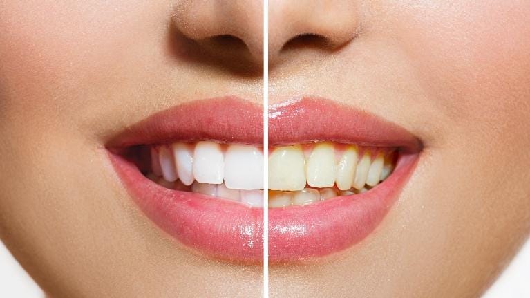 Zoom Whitening Zoom Whitening
