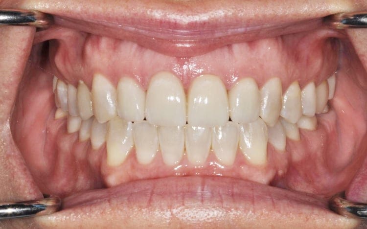 7 (1). Patient MB (4 teeth)_ 4 porcelain veneers on front teeth After