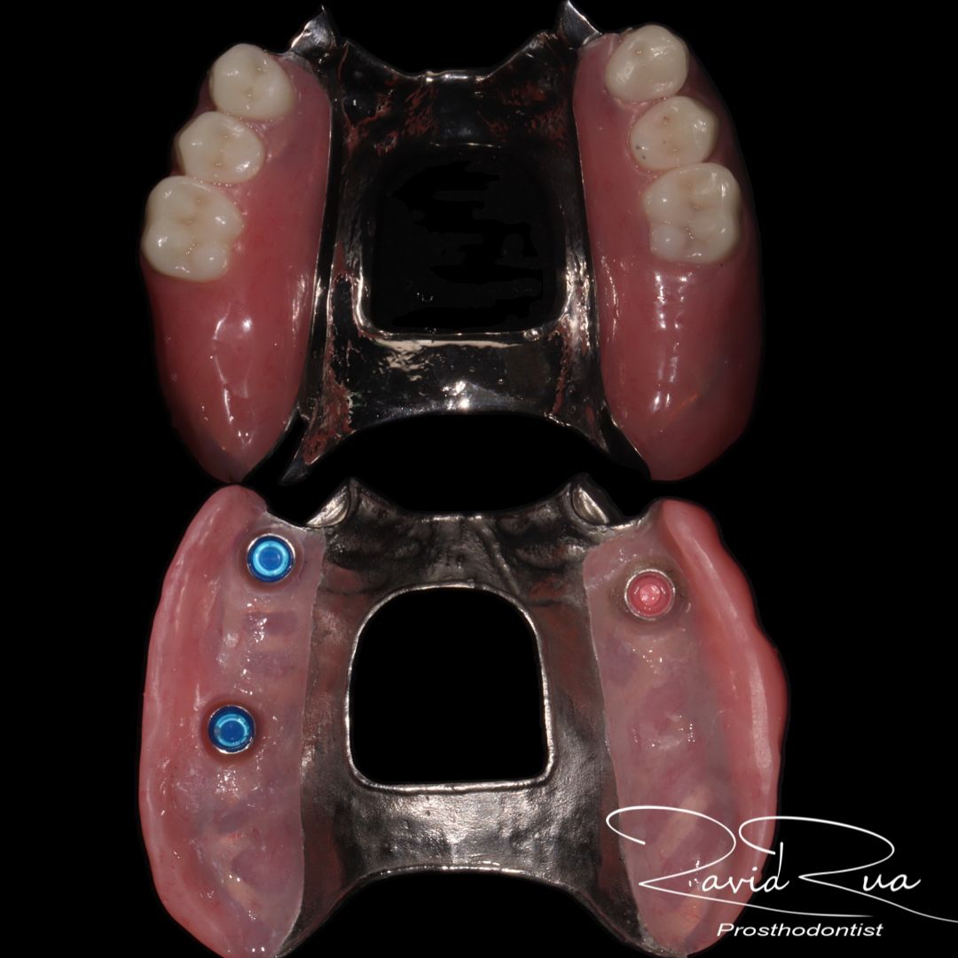 TC Cape Coral Case 19.2 Full mouth rehab, Implants , crowns and partial