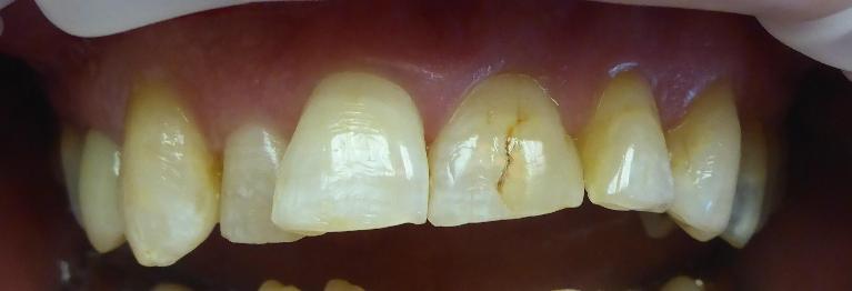 Grapevine Before Cosmetic Veneers