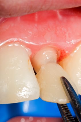 DENTAL VENEERS