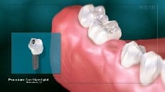 Screw-Retained Implant 001
