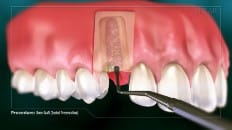 Bone Graft (Socket Preservation) 002