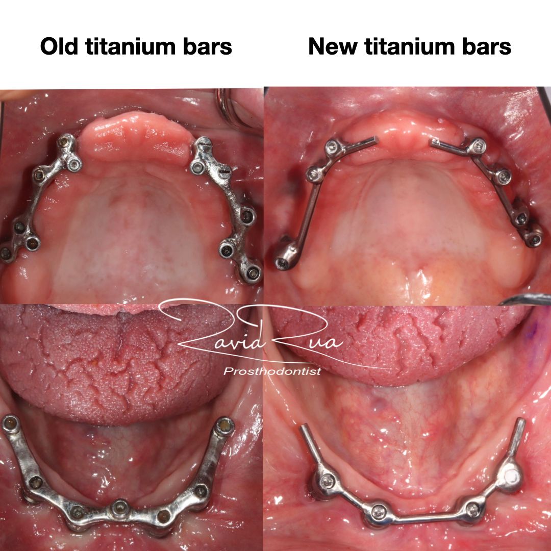 TC Cape Coral Case 9.2 Top and Bottom implants/bar supported overdentures
