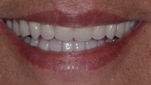 Dental Implants After