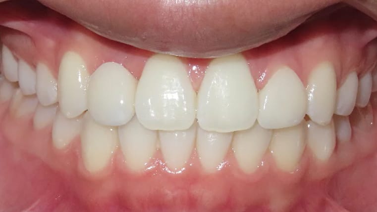 BF Ortho Smile Gallery After